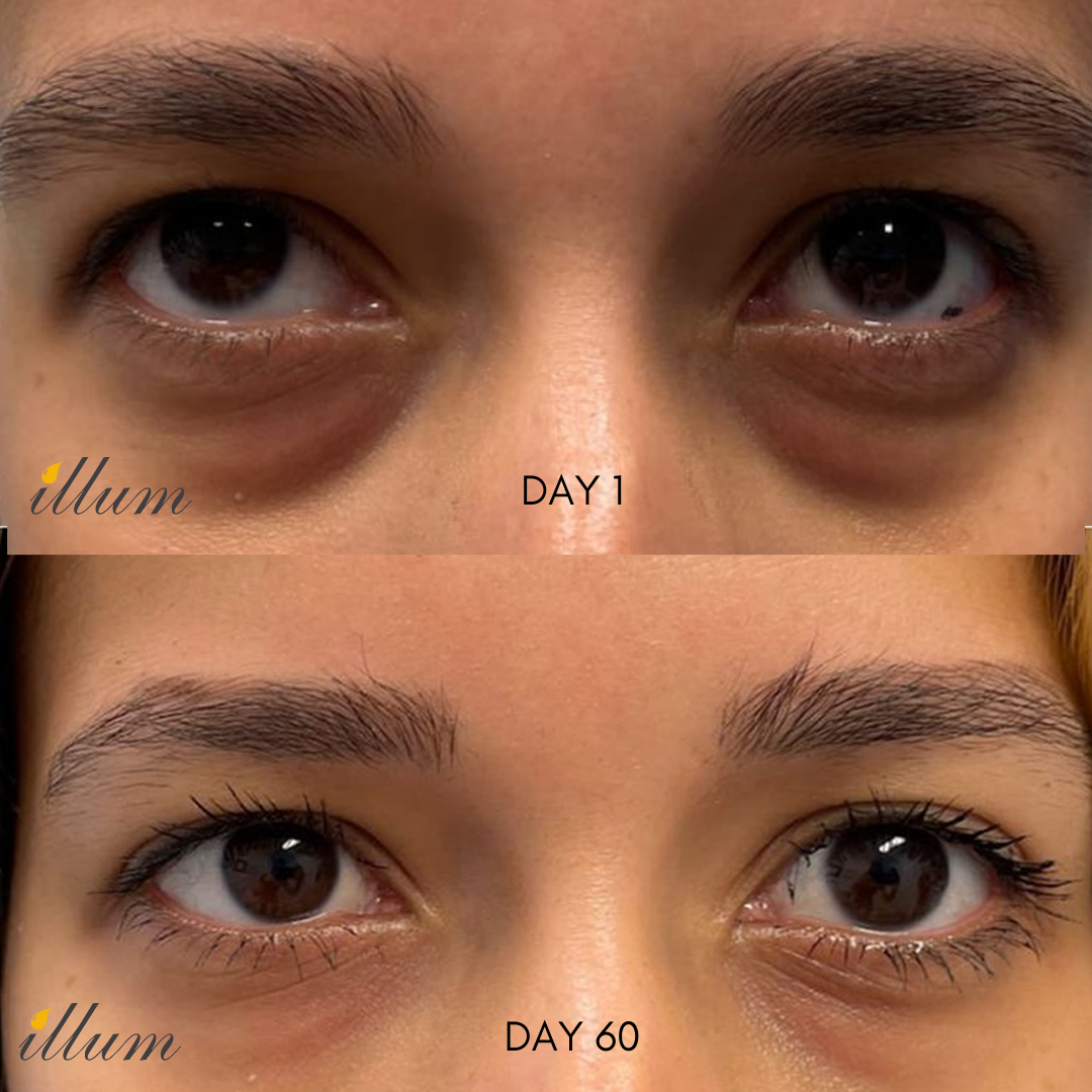 Dark Circles Treatment