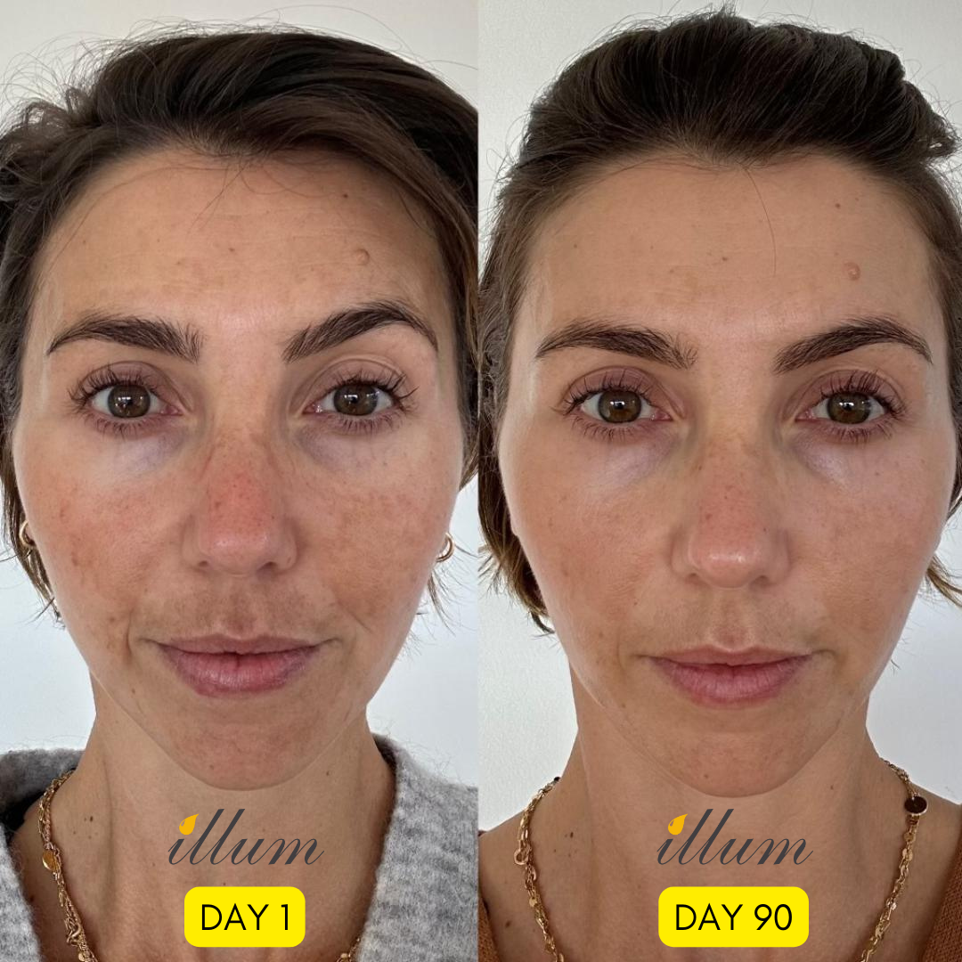 Le Pigmentum - Hyperpigmentation Treatment
