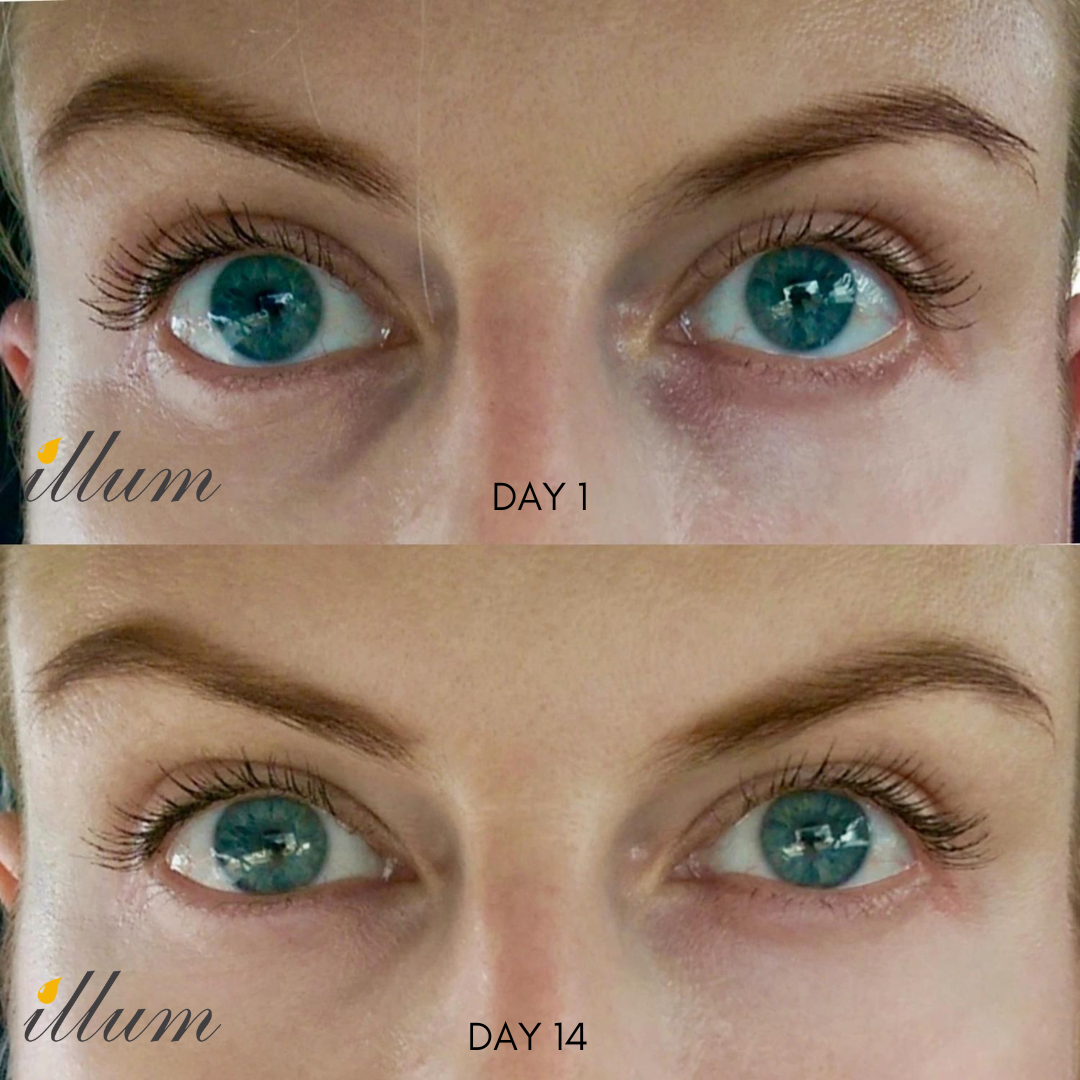 Dark Circles Treatment
